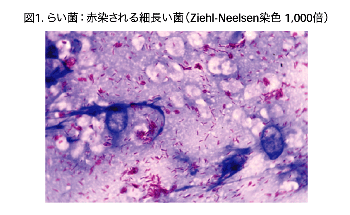 らい菌を示すZiehl-Neelsen染色の顕微鏡写真(1,000倍)。細長い赤色の菌体(らい菌)が青紫色の背景に散在している。